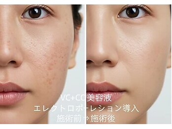 憩いサロン ユリ(yuri)/エレクトロポーレション導入