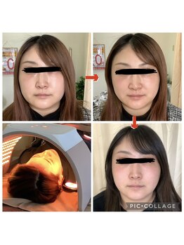 かず整骨院/光美容で小顔と美白!