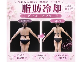 ルフレの写真/最新痩身★脂肪冷却×看護師による施術で理想のボディラインに♪初回限定★脂肪冷却2カップ￥9,800円～