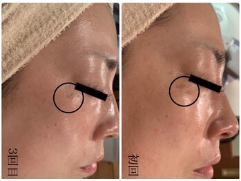 ビーフリー(Be free)/