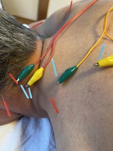 ライズ/頚部への通電の施術