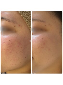 シューティングハーツ(SHOOTING HEARTS)/ハーブピーリング