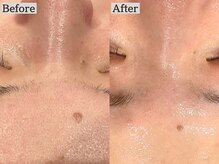 あすはれ/フェイシャルワックスで毛穴ケア