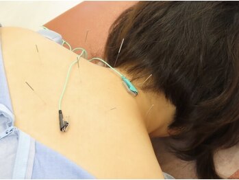 瑞江駅前はりきゅう整骨院/当院で人気の鍼灸施術!