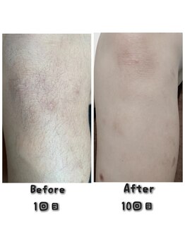 プロジェクトサン ムーンベル(PROjECTSuN Moonbell)/中学生 脱毛