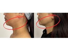 ソルニコン(Solnikon)/若見え小顔術