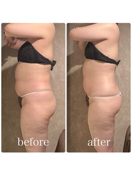 ブリス(BLiSS)/月2回のペース 1回の効果☆