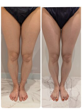 セルノヴァ(Cell Nova)/下半身痩身/痩身ダイエット