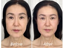 ドクターボディ 新宿店(Dr.Body)/【顔の長さ/大きさ/たるみ50代】