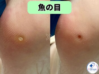 プラスワンフット 本厚木(+1 Foot)/タコ・魚の目ケア！痛みから解放