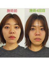 シャルム(Charme)/小顔矯正施術４回