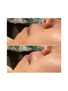 アデル 久留米(ADEL)/《全顔》口元ワックス