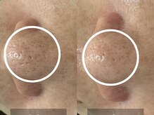 ゴホウビ オキナワ(GOHOBI OKINAWA)/黒ずみぽつぽつ毛穴にさよなら♪