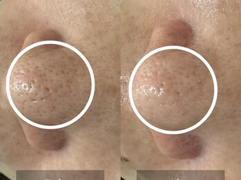 ゴホウビ オキナワ(GOHOBI OKINAWA)/黒ずみぽつぽつ毛穴にさよなら♪