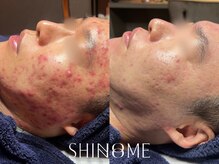 シノノメ(SHINONOME)/*長年の赤みケア