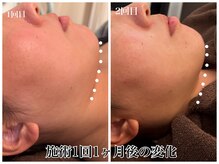 リラ(Lilas)/人生ラストダイエット