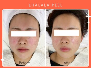 ハノハノ 八代店(HANO HANO)/韓国肌管理ララピール☆