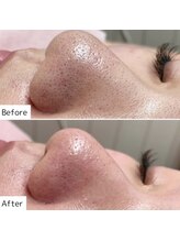 ホワイトラボ ライカム前店(White labo)/毛穴ケア☆毛穴洗浄×ピーリング