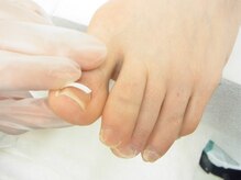 ロワの雰囲気（巻き爪補正の施術）