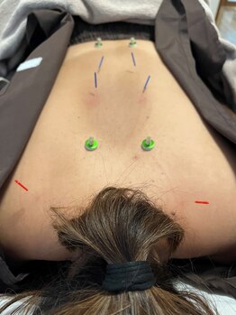 ロノ(Lono)の写真/≪女性鍼灸師がしっかり対応◎≫ついつい我慢しがちな、プチ不調…。鍼灸の力でスッキリ解消しませんか？