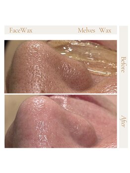 メルベスワックス(MELVES WAX)/フェイスダブル脱毛