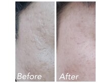 白美/韓国肌管理／ララピール／毛穴