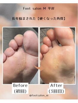 【タコ/魚の目】40代女性