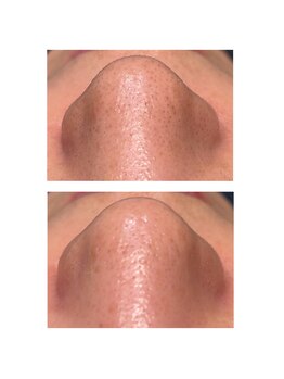 ディシェーレ アスト/ハイドロフェイシャル