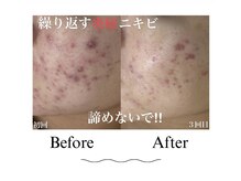 マイレ 平塚店(Maile)/繰り返すニキビ