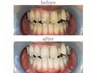 ホワイトニング【オープン記念★人気No.1】高濃度 45分