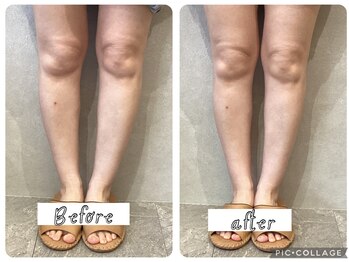 グランツ(glanz)/О脚やX脚、膝痛、腰痛に☆