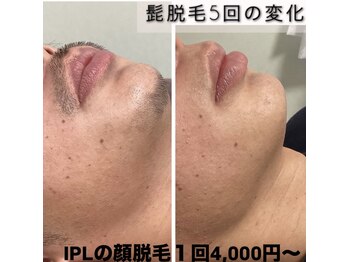 メロスの写真/先着5名!《赤字覚悟のヒゲ脱毛》やってよかったメンズ美容は脱毛!?清潔感の鍵は”毛”にあり!