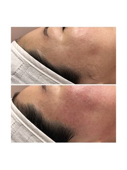 ホワイトワックス 京都四条烏丸(WHITE WAX)/《全顔》フェイシャルワックス