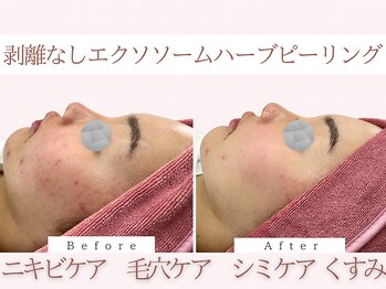 Cスキンケアクリニック 麻布店/毛穴洗浄×ハーブピーリング