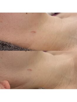 ヴェルシック(Belchic)/顎下とフェイスラインのむくみも