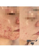 カルム エ コンポーゼ(Calme et Compose')/REVIハーブ／6回