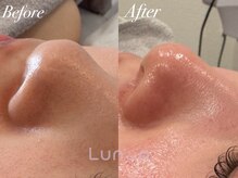 ルノン(Lunon)/毛穴洗浄ハイドロ×ララピール