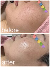 エシャーム(echarme)/カーボンピーリング