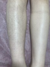 ビジュー(Bijou)/#膝下ワックス脱毛