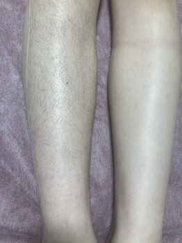 ビジュー(Bijou)/#膝下ワックス脱毛