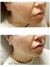 リムー(RE@Muu)/ストレートネック