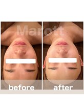 マロット 表参道店(Marott)/【20代女性】肌質改善ピーリング