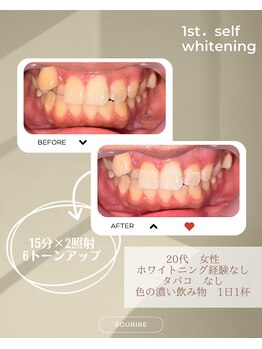 スリール(sourire)/ホワイトニング