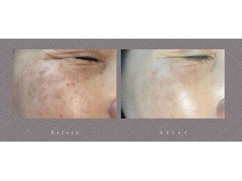 ミハン ボーテ(mihan.beaute)/【シミ・くすみ・色素沈着】