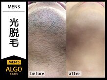 アルゴ 敦賀店(ALGO)/３０代男性８回目　メンズ髭脱毛