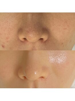 結(musubi)の写真/韓国最新ピーリング★セラピールで憧れの透明&美白肌へ~ほうれい線&たるみケアに効果◎憧れの水光艶肌へ