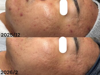 エクラ(eclat)の写真/【都度払いOK】6,900からお得な定額制プランもご用意しております。毛穴・ニキビケアは肌に合わせた施術を