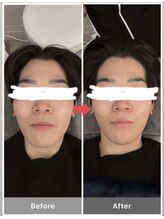 ビオナス 高田馬場店(BIONAS)/フェイスラインケア症例写真☆