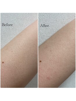 脱毛専門店 ハブ ア グッデイ(Have a good day!)/産毛にも効果大！♪