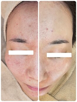 クレイルサロン(Claire salon)/本気の肌質改善ハーブピーリング